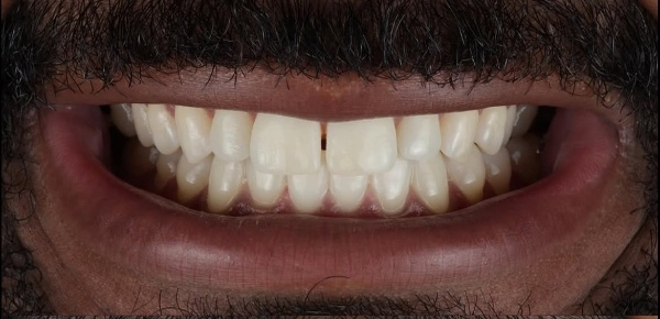 Before